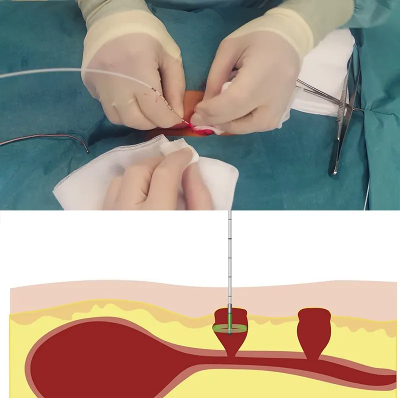 لیزر کیست مویی