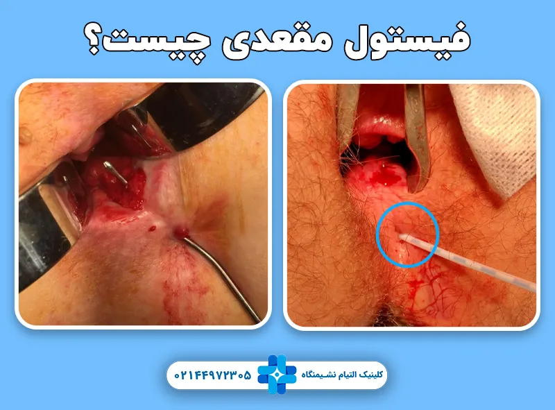 فیستول مقعد چیست