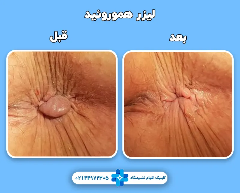 قبل و بعد لیزر بواسیر