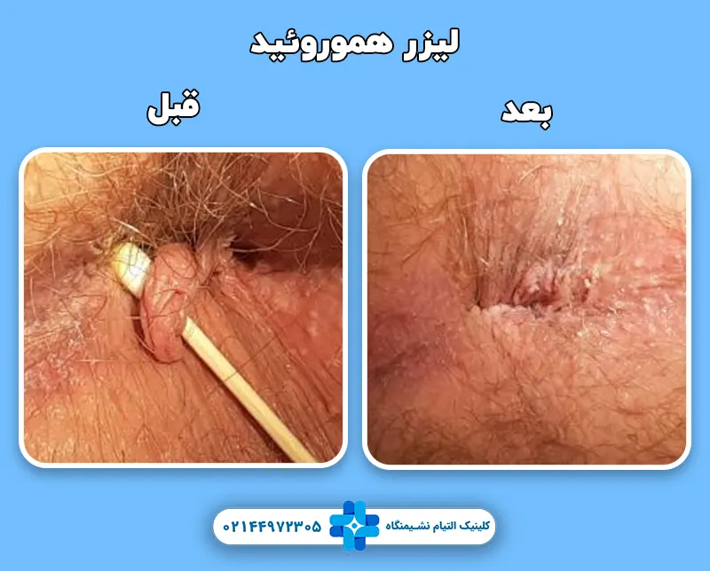 قبل و بعد لیزر همورئید