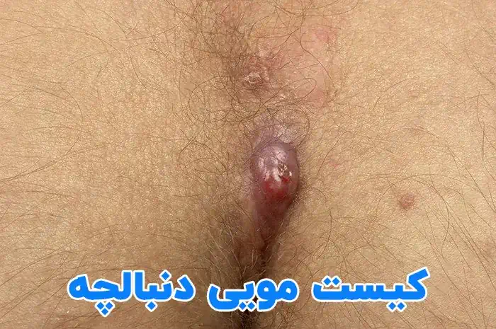 عفونت کیست مویی