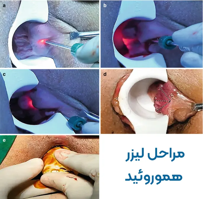 مرحل لیزر همورئید