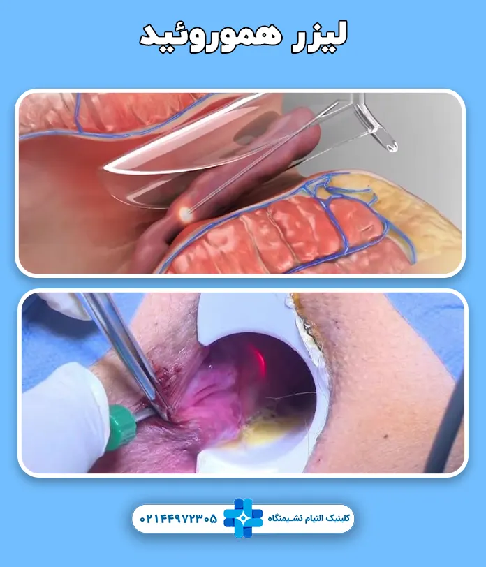 لیزر هموروئید