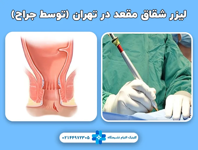 لیزر شقاق مقعد در تهران