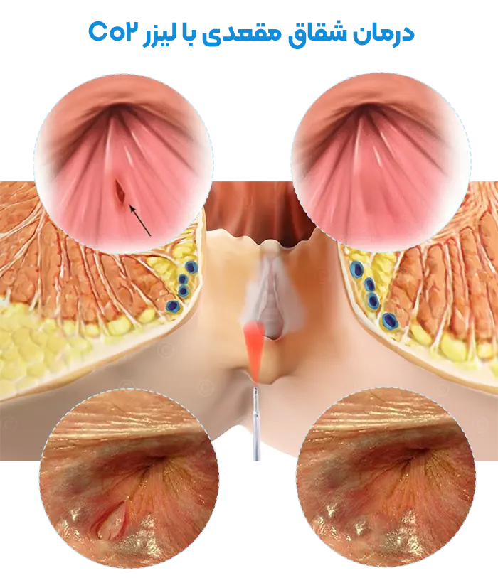 قبل و بعد لیزر شقاق
