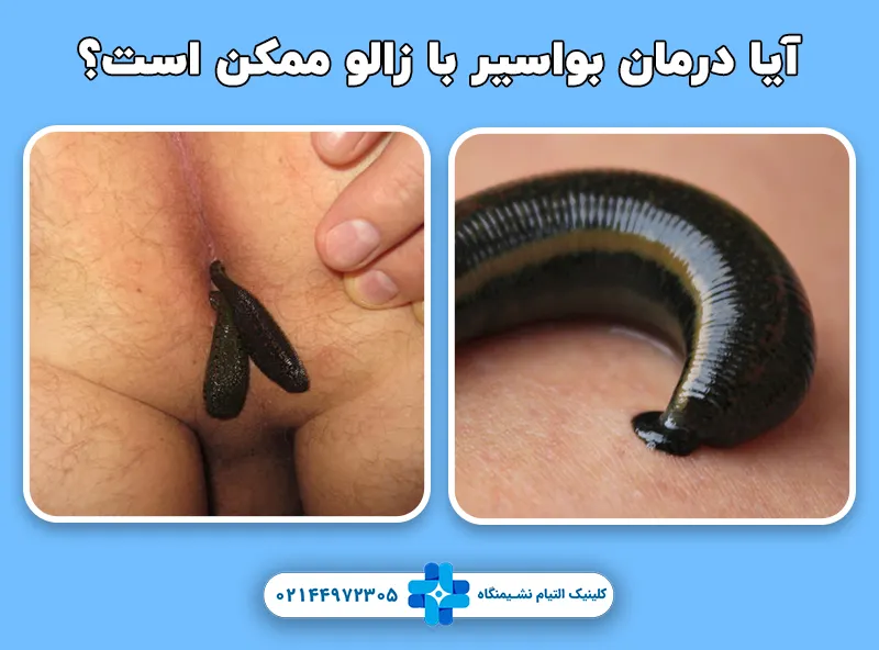 درمان بواسیر با زالو