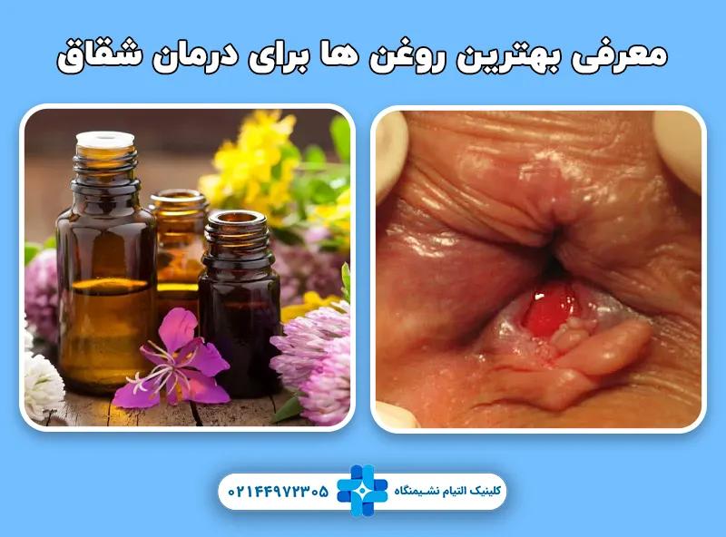 معرفی بهترین روغن ها برای درمان شقاق