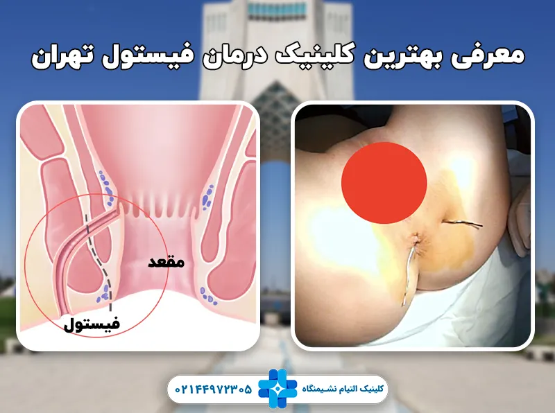 بهترین کلینیک درمان فیستول تهران