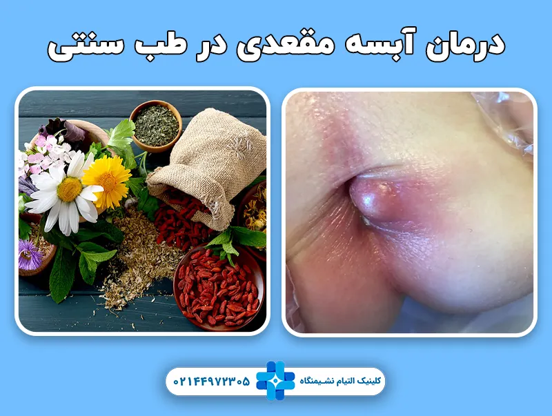 درمان آبسه مقعدی در طب سنتی