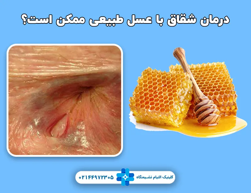 درمان شقاق مقعدی با عسل