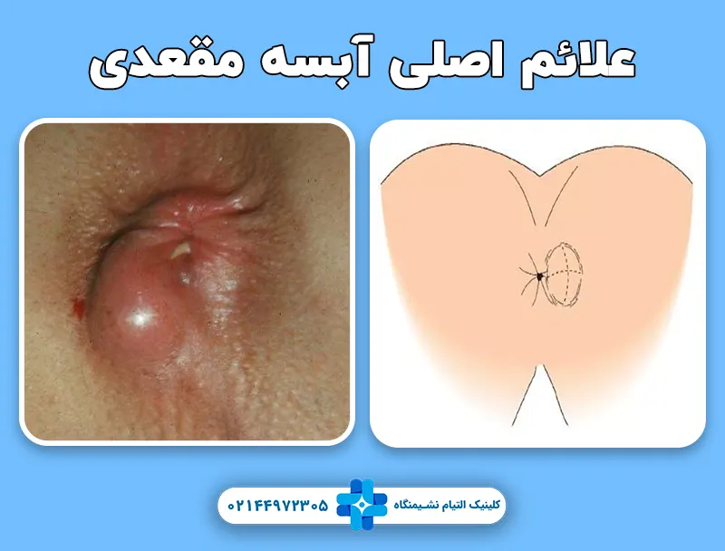 علائم اصلی آبسه مقعدی