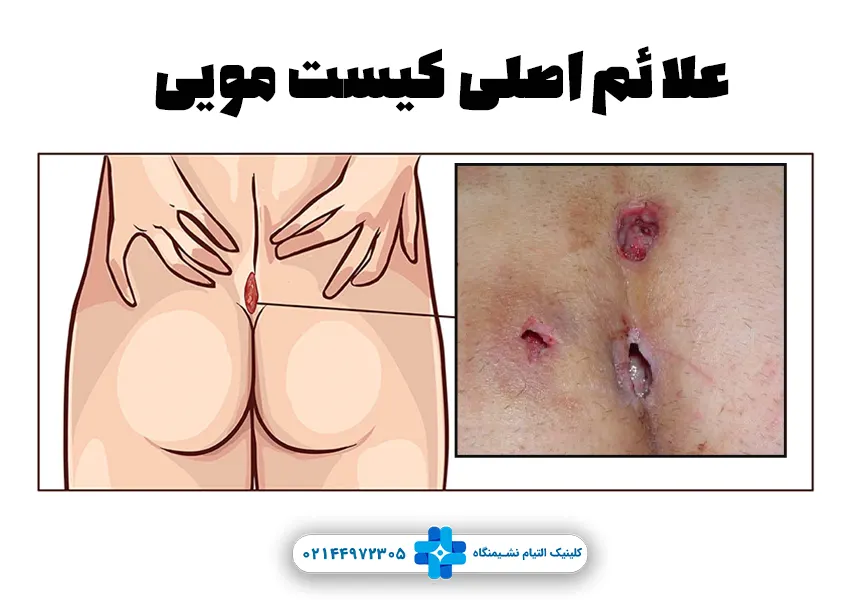 علائم کیست مویی