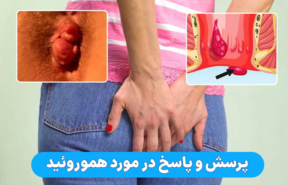 پرسش و پاسخ در مورد هموروئید
