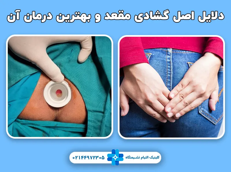 گشادی مقعد و درمان آن