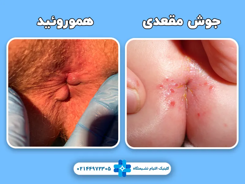 جوش مقعدی -هموروئید