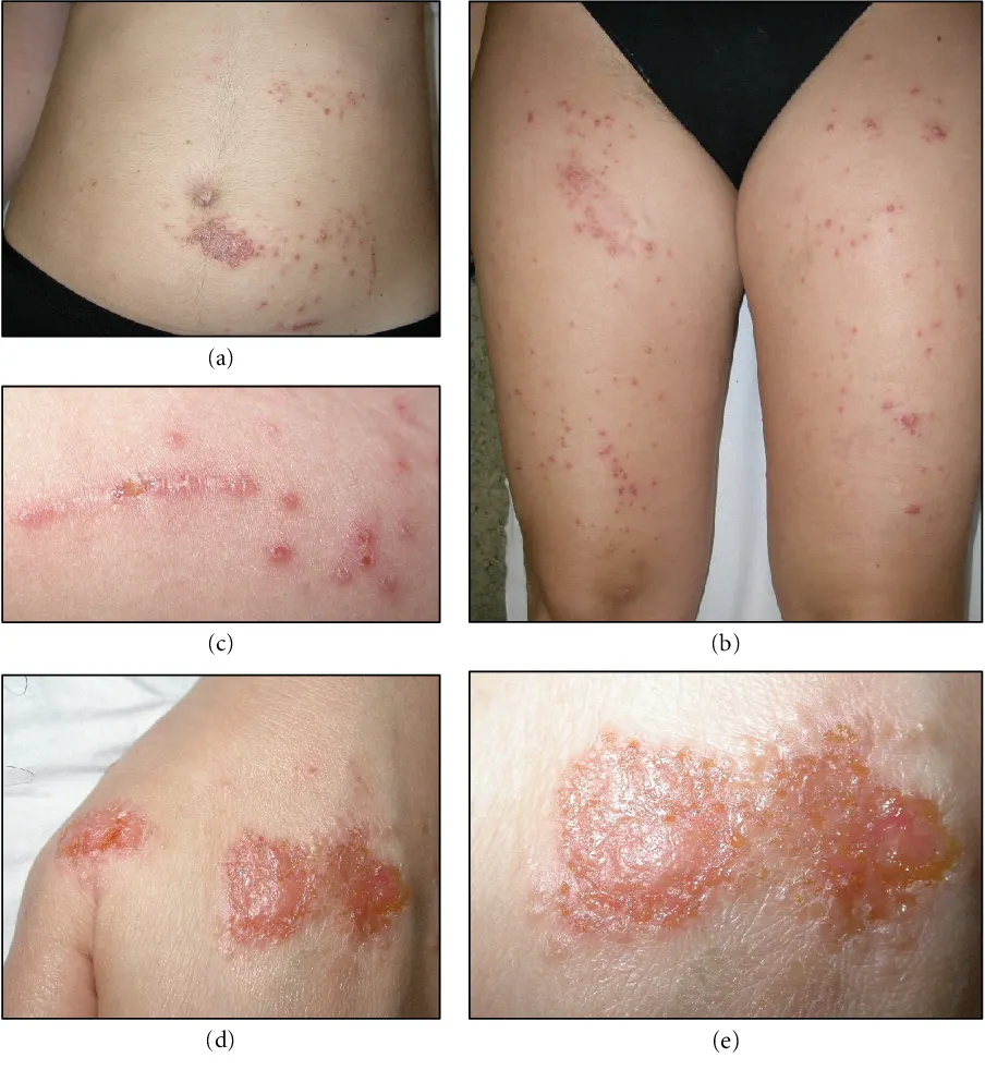 عوارض بیماری سلیاک