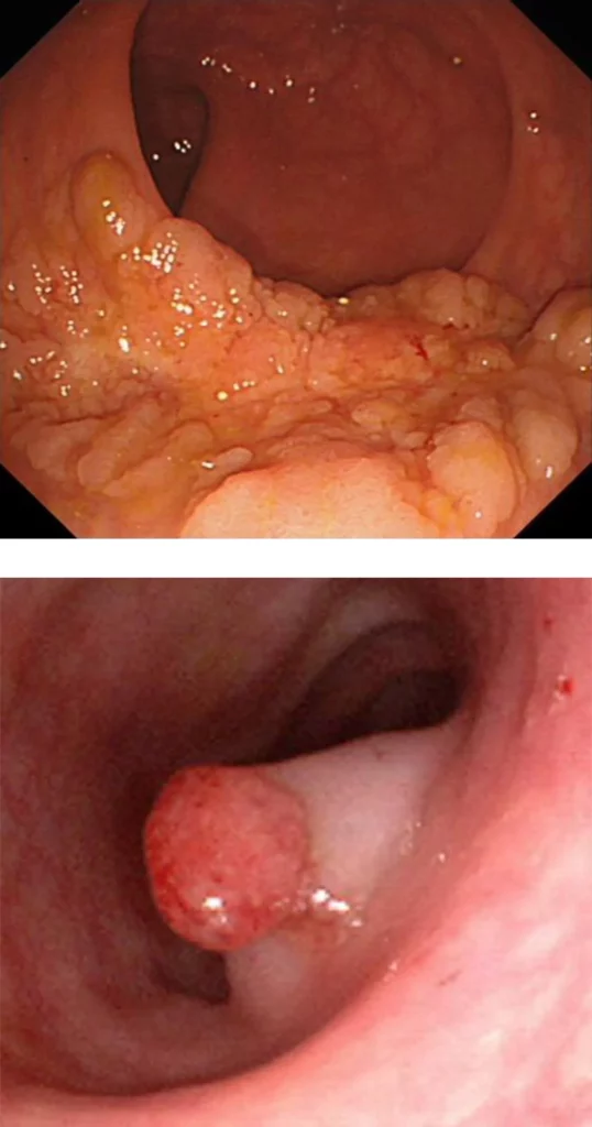 پولیپ مقعدی