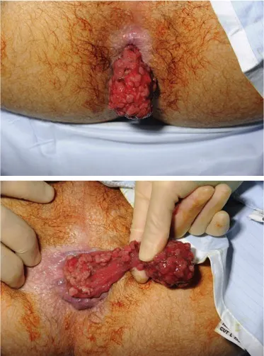 پولیپ مقعدی