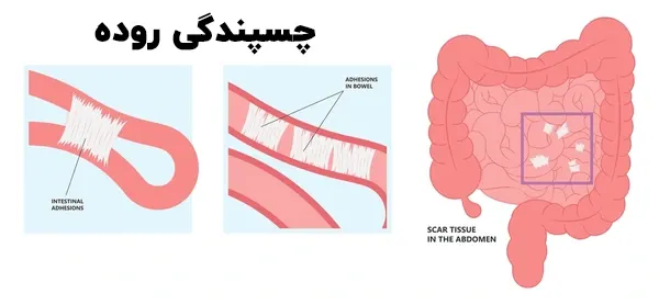 چسبندگی روده