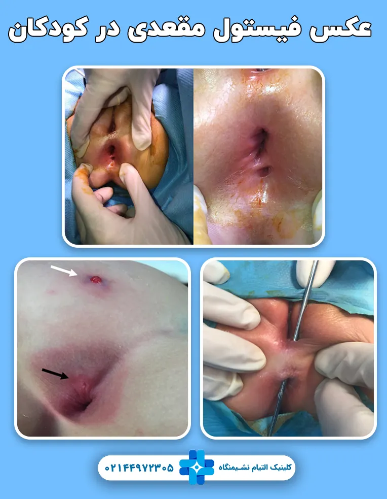 فیستول مقعدی در کودکان