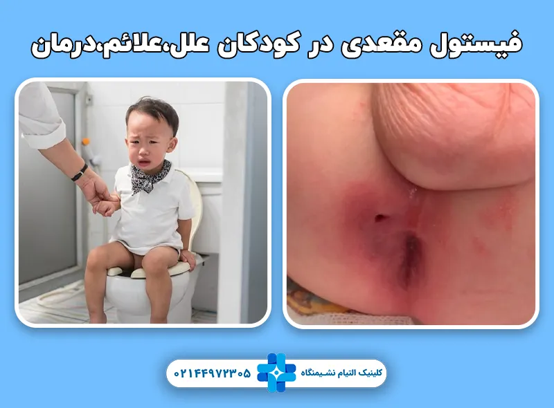 دلیل فیستول مقعدی در کودکان و نحوه درمان آن