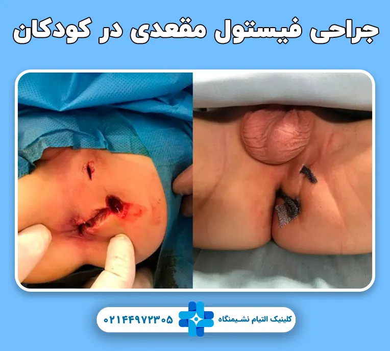 جراحی فیستول مقعد در کودکان