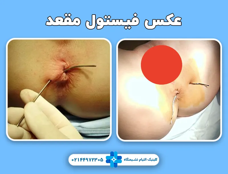 فیستول مقعدی