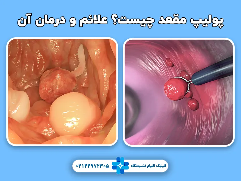 پولیپ مقعد یا رکتوم چیست