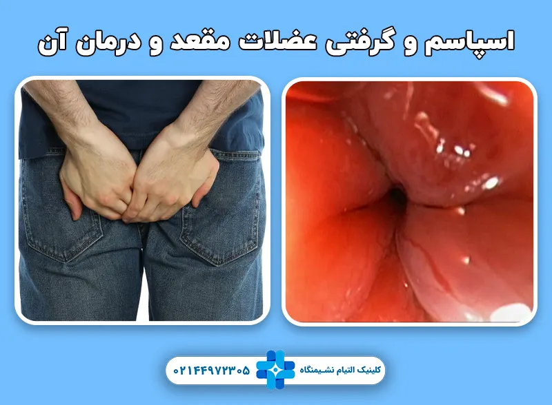 اسپاسم و گرفتی عضلات مقعد