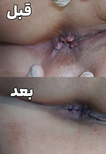 عکس قبل و بعد بواسیر