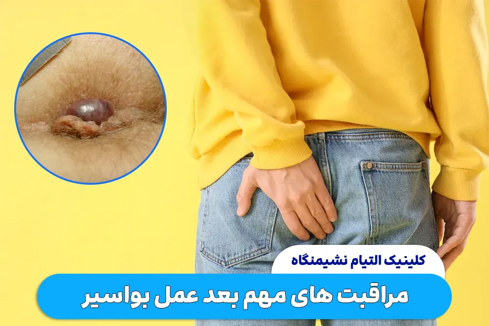 لیست مراقبت های مهم بعد عمل بواسیر