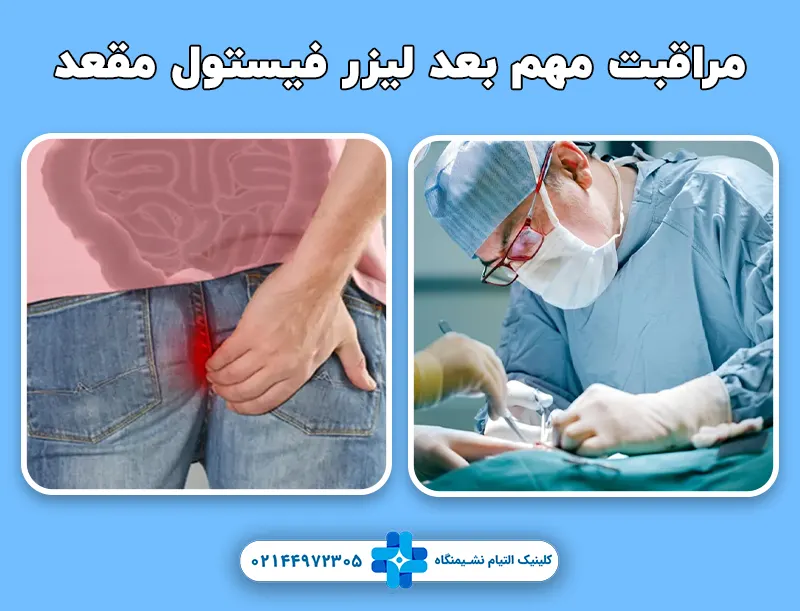 مراقبت های مهم بعد جراحی لیزری فیستول