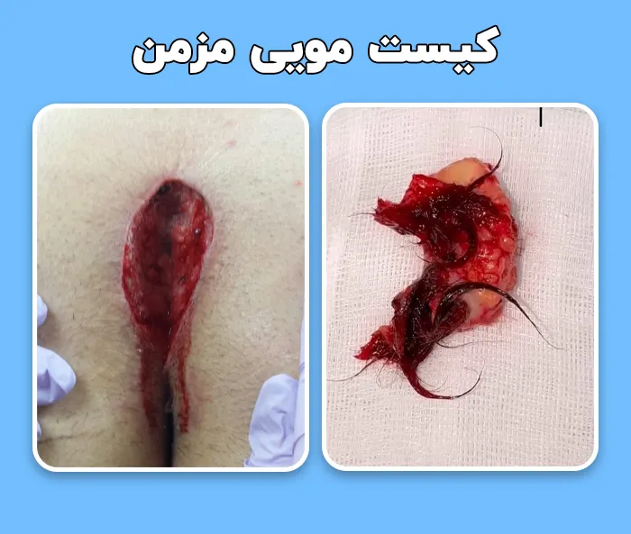 کیست مویی مزمن