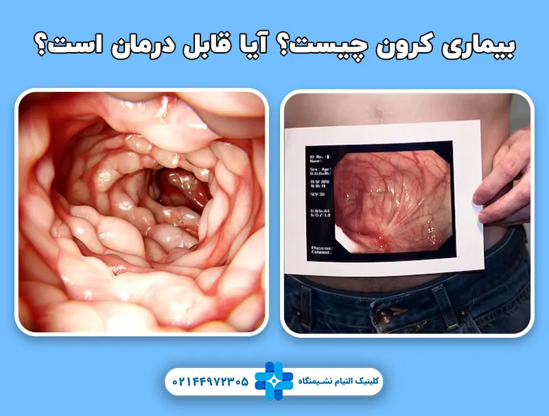 بیماری کرون