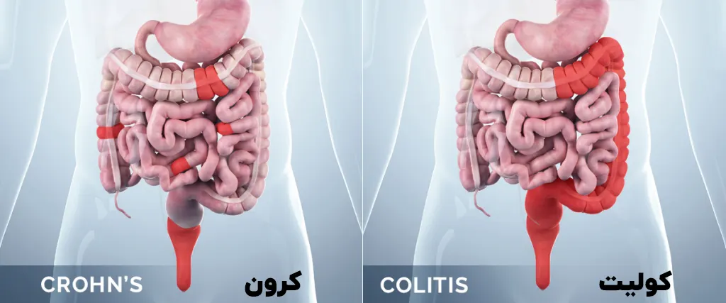 تفاوت بیماری کولیت و کرون
