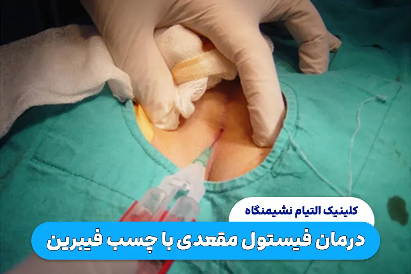 درمان فیستول مقعدی با چسب فیبرین؟