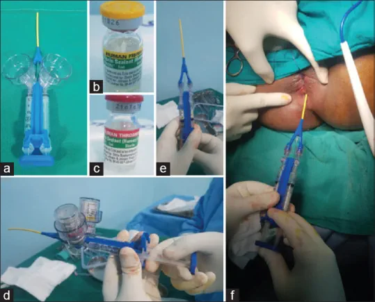درمان فیستول مقعدی با چسب فیبرین