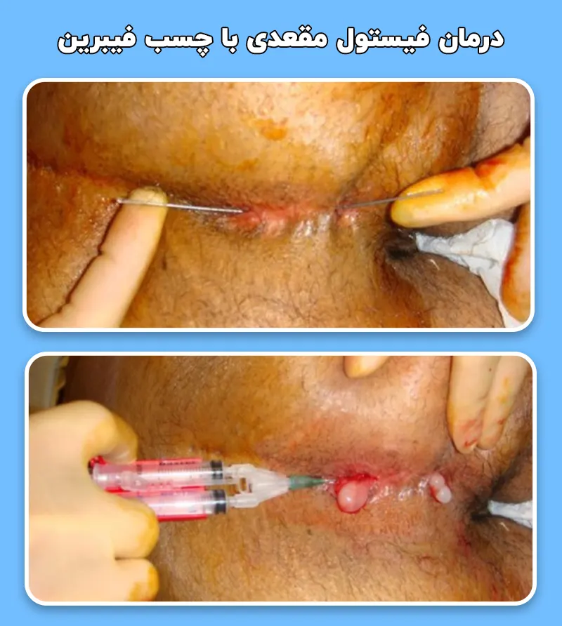 درمان فیستول مقعدی با چسب فیبرین