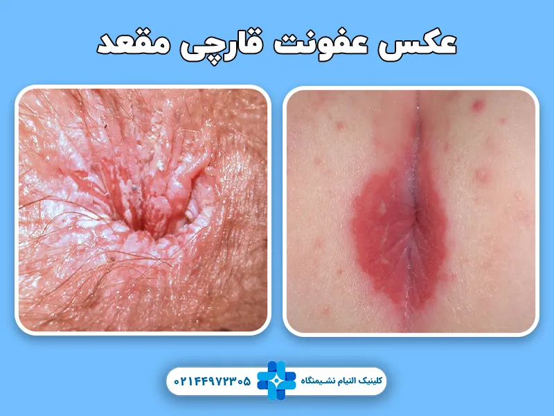 عفونت قارچی مقعد