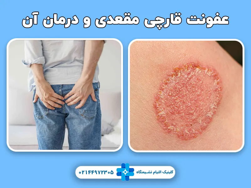 عفونت قارچی مقعد