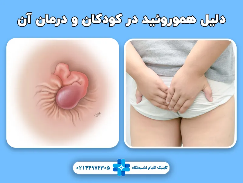 هموروئید در کودکان