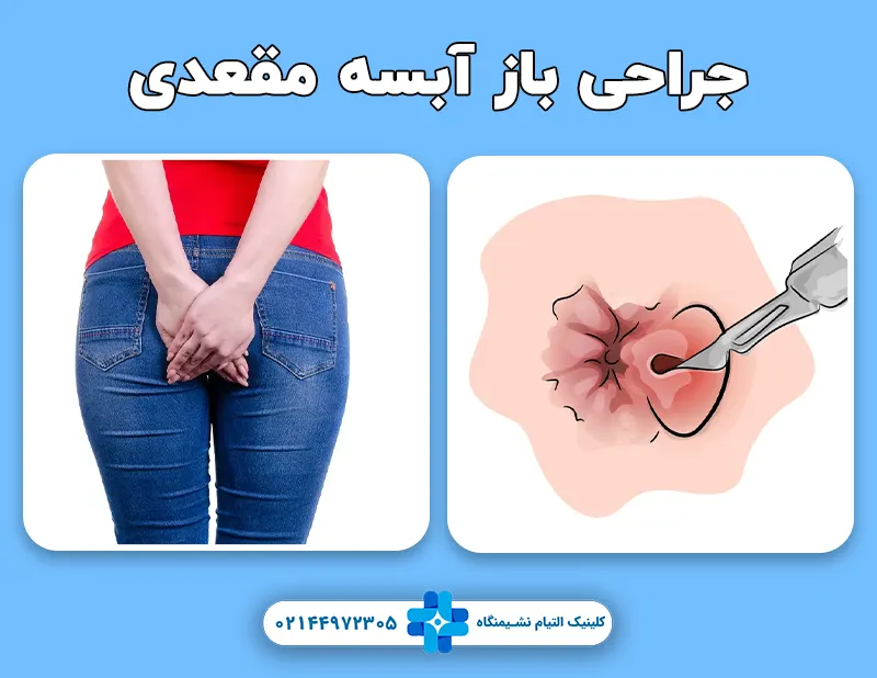 جراحی باز آبسه مقعدی