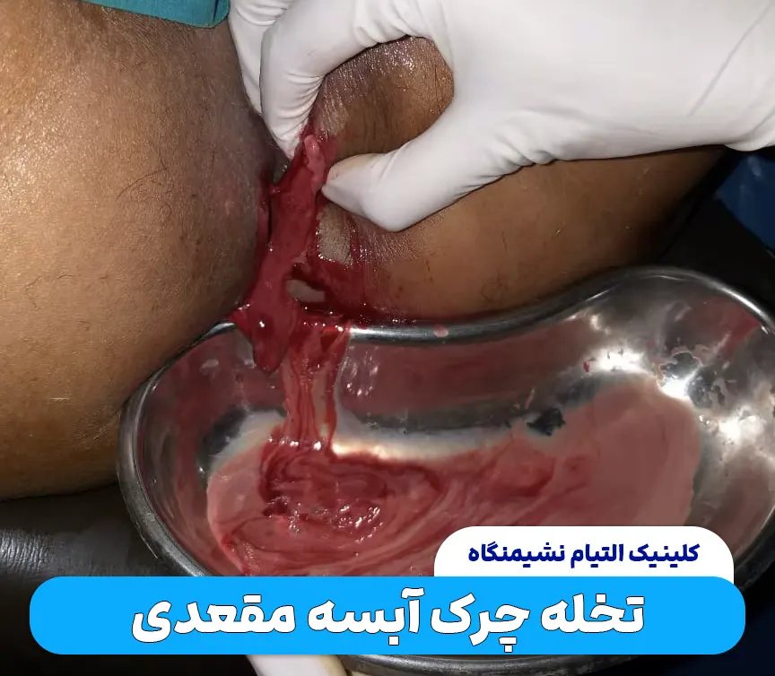 تخلیه آبسه مقعدی
