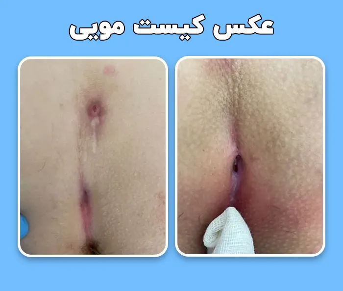 عکس کیست مویی