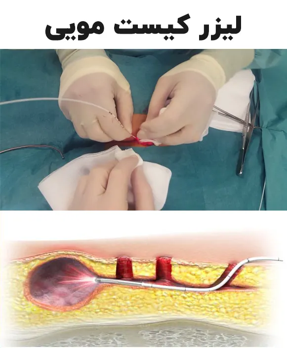 لیزر کیست مویی
