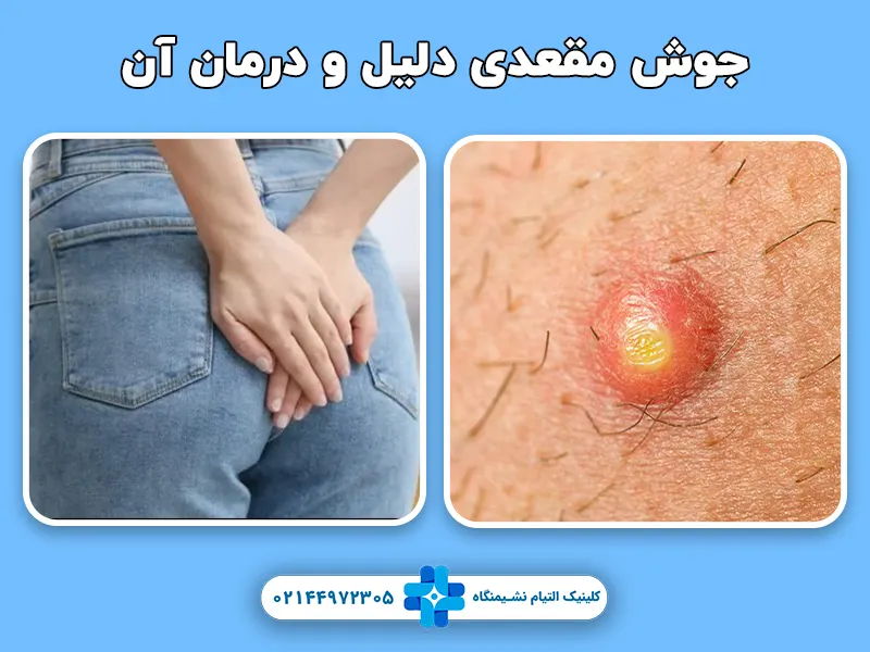 جوش مقعدی دلیل و درمان آن
