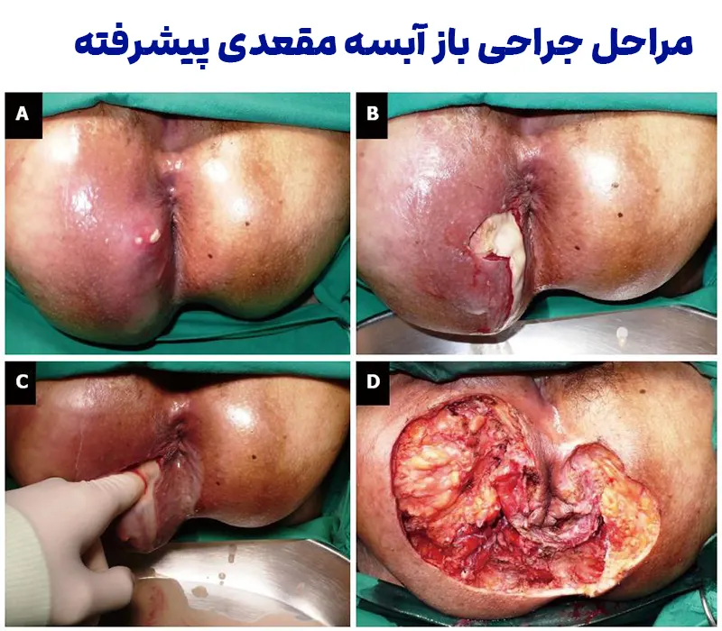 جراحی باز آبسه مقعدی