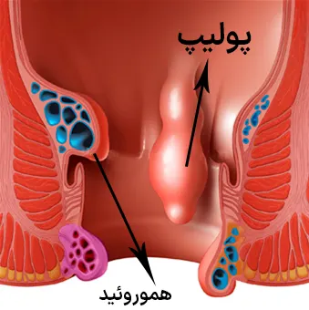 تفاوت پولیپ و هموروئید
