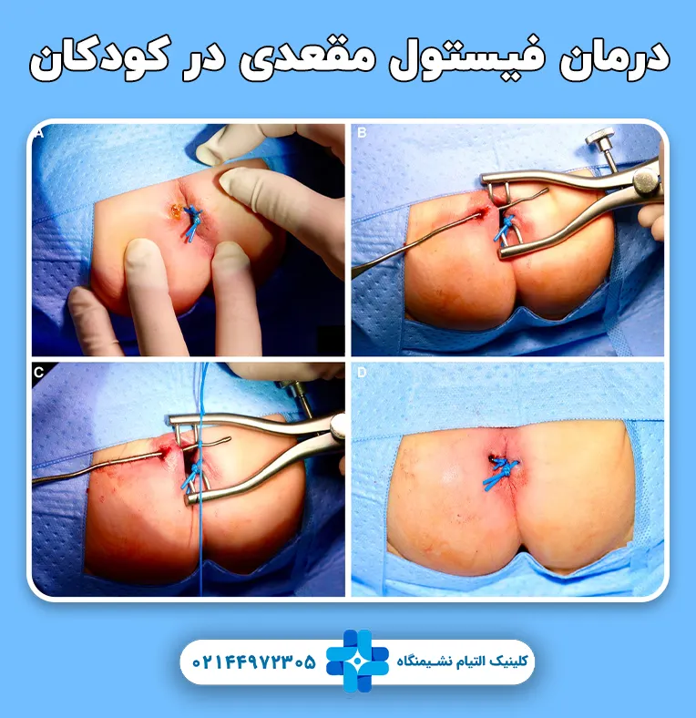 درمان فیستول مقعد در کودکان