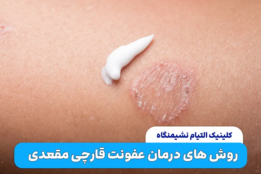 درمان‌ عفونت قارچی مقعد